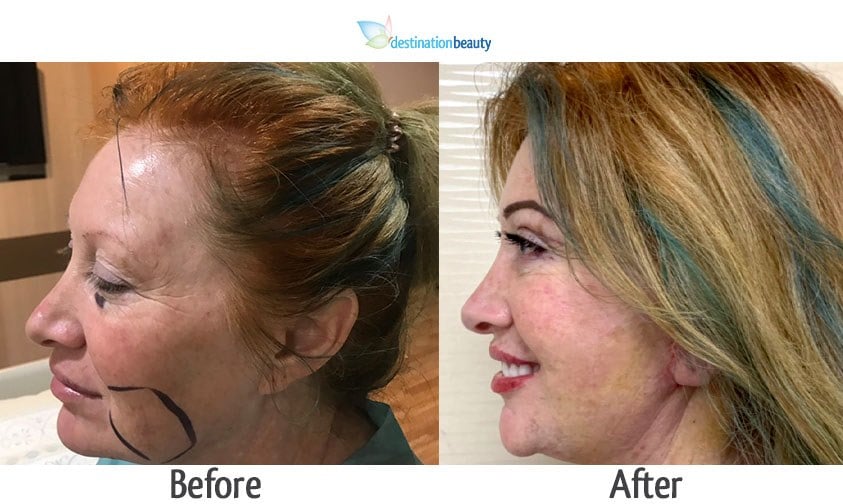 Face lift surgery and eyelid surgery in Thailand! See Ally's incredible